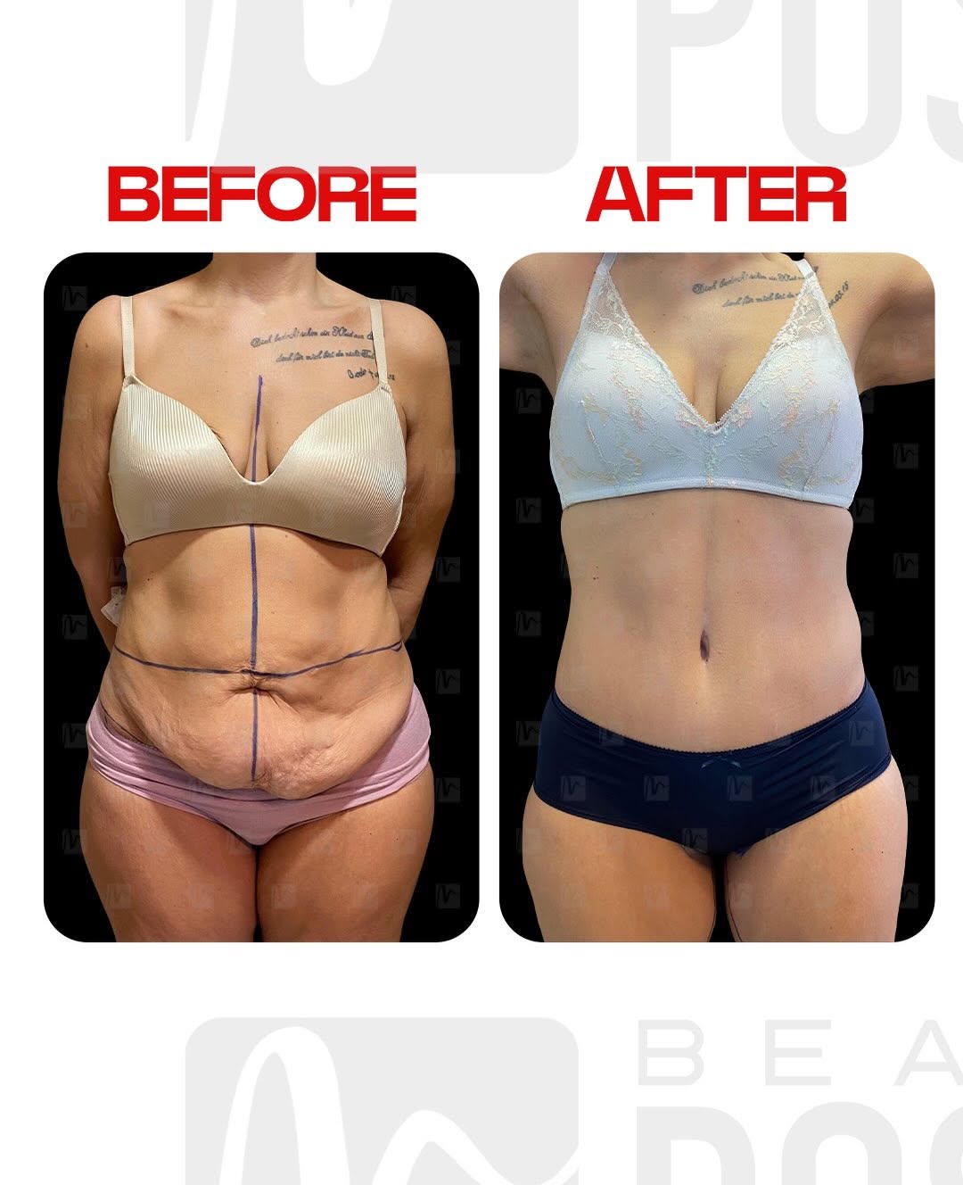 360 Body Lift Sonrası