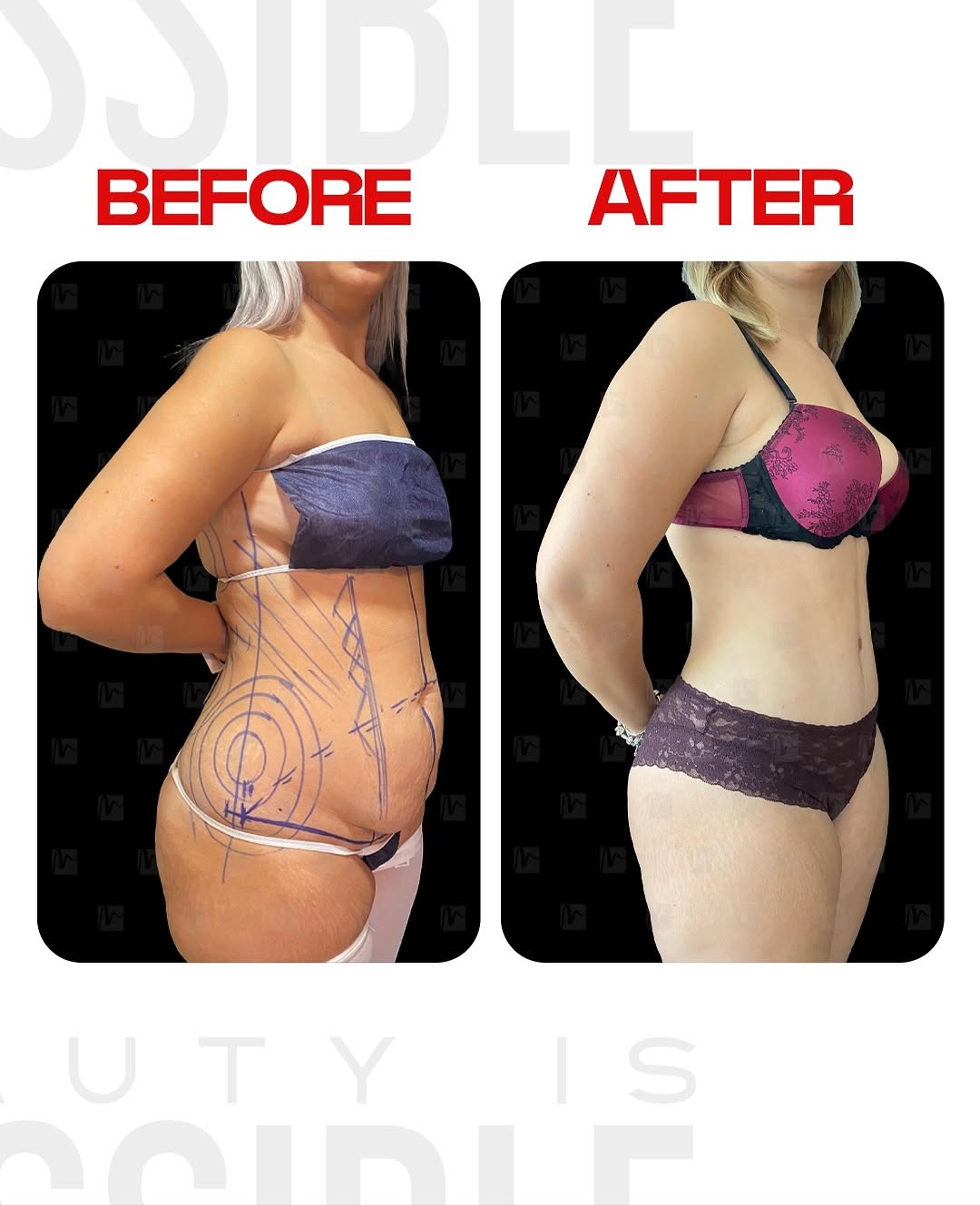 Estetik cerrahi vaka örneği 2