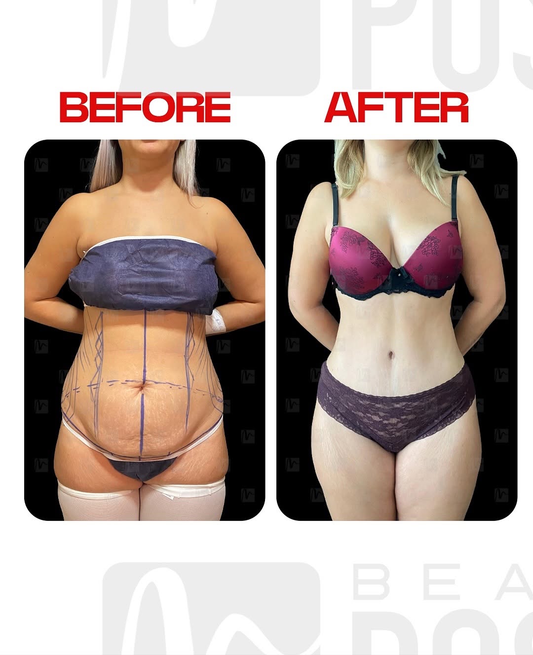 Ameliyat Sonrası — Karın Germe